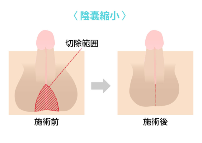 睾丸（金玉）に生えている毛は処理した方がいい？ 自己処理の方法や注意点、脱毛に関する疑問についても解説 - 