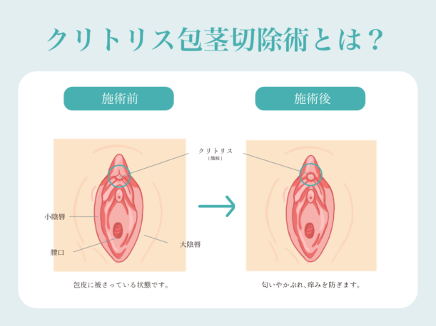 デリケートゾーンに「できもの」が…これは病気？しこりやブツブツの原因と対処法【医師監修】 - ワタファク