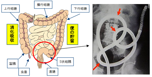 S状結腸憩室症 大腸憩室症の教科書を執筆しました |