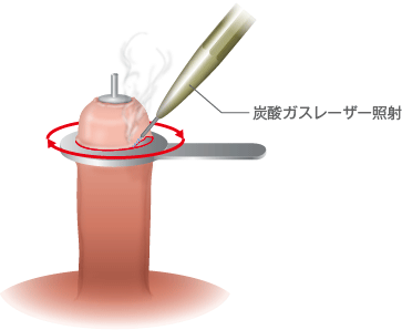 仮性包茎について – メンズ形成外科 | 青山セレス&船橋中央クリニック