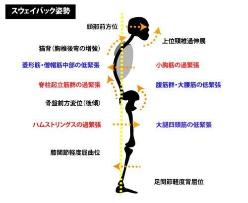 スウェイバック姿勢 | はっとりはりきゅう接骨院グループ