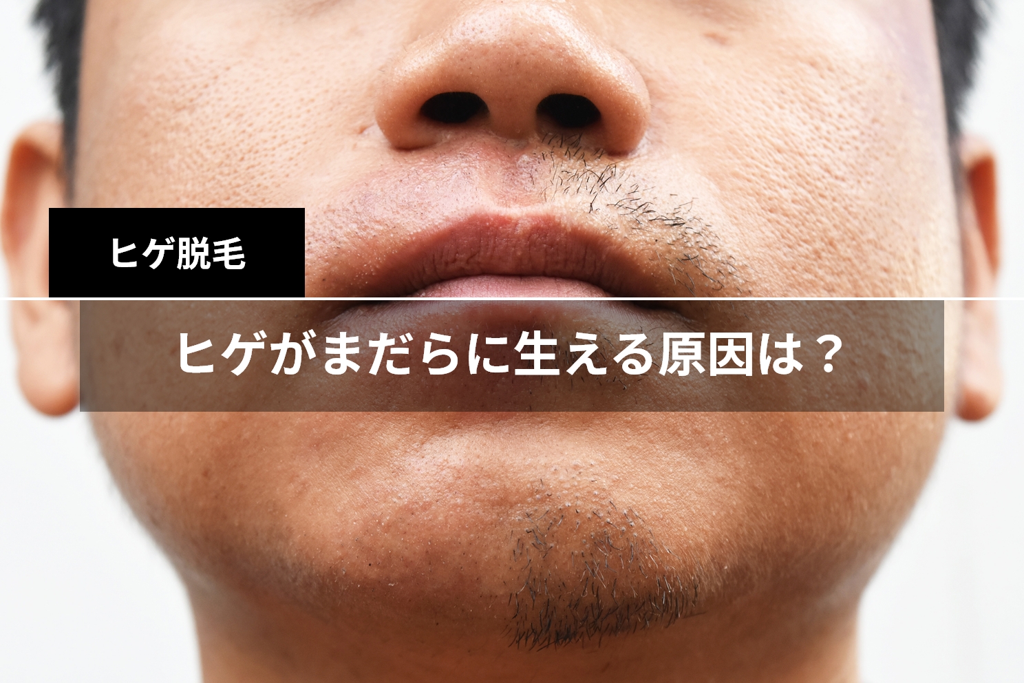 実体験】中学生からヒゲを抜き続けたら薄くなった話【30代まで】