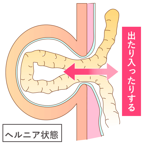 鼠径部イラスト｜無料イラスト・フリー素材なら「イラストAC」