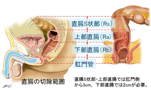 S状結腸の写真素材 - PIXTA