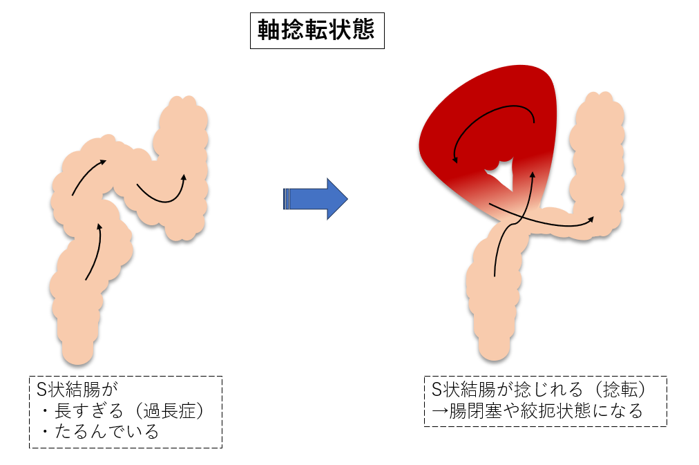 S状結腸軸捻転症｜オリンパス おなかの健康ドットコム